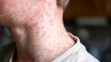 Measles vaccine being administered in Ontario