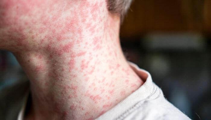 Measles vaccine being administered in Ontario